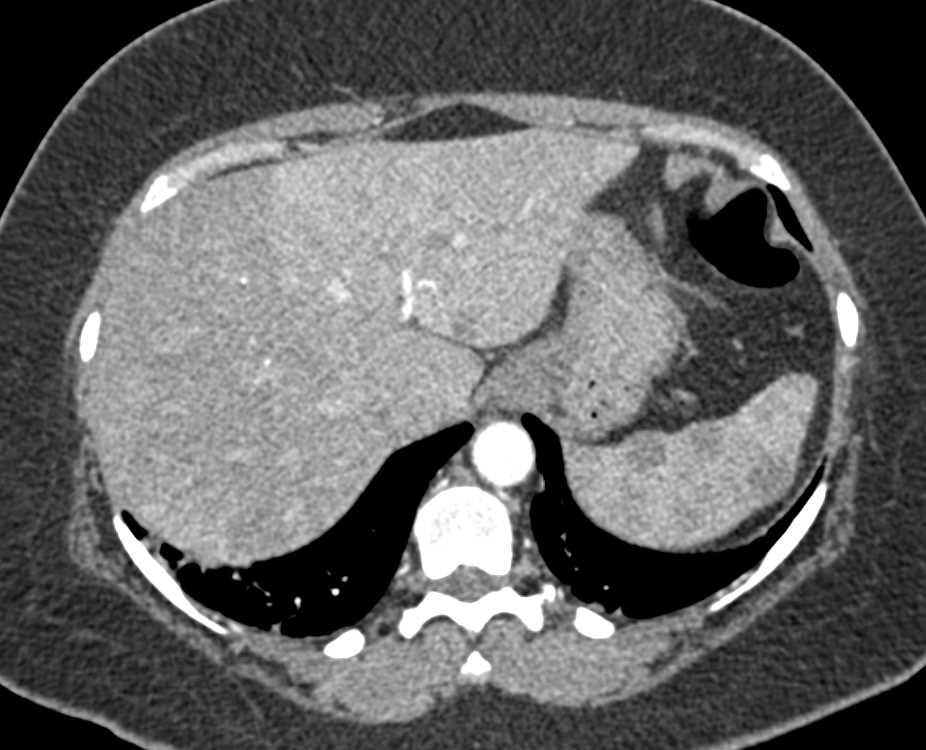 Pancreatic Cancer with Peripancreatic Adenopathy - CTisus CT Scan