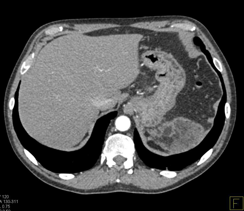 Omental Infarct Left Upper Quadrant Following Distal Pancreatectomy and Splenectomy - CTisus CT Scan