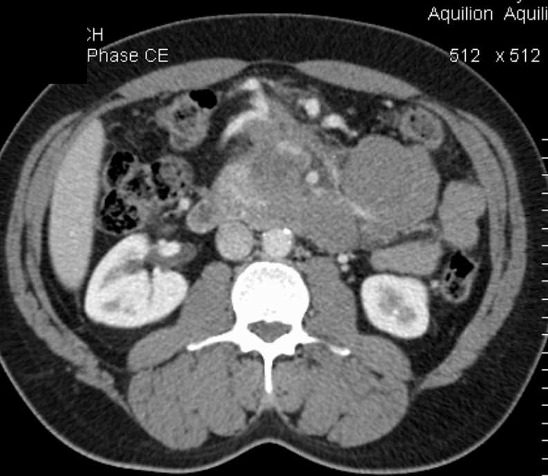 Lymphoma Infiltrates the Pancreas and Mesentery - CTisus CT Scan