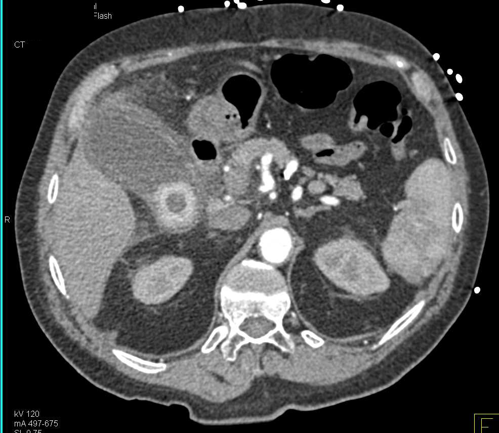 Acute Cholecystitis with Inflamed Gallbladder - CTisus CT Scan