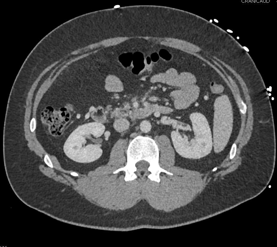 Inflammation with Nodes in the Mesentery - CTisus CT Scan