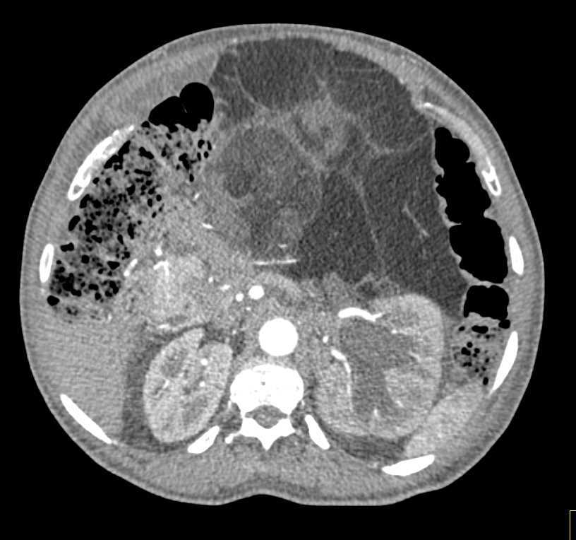 Retroperitoneal Liposarcoma and Renal Cell Carcinoma - CTisus CT Scan