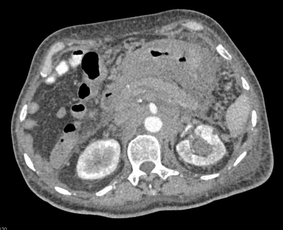 Lymphoma with Multiorgan Involvement and Adenopathy - CTisus CT Scan