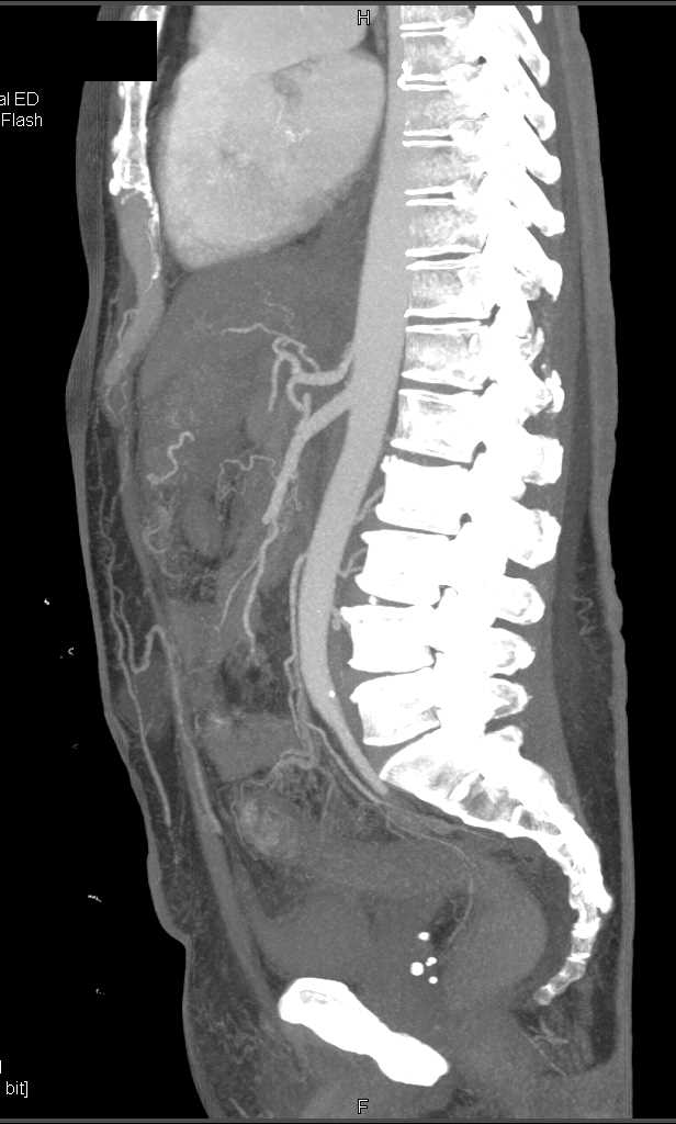 Lymphoma with Multiorgan Involvement and Adenopathy - CTisus CT Scan