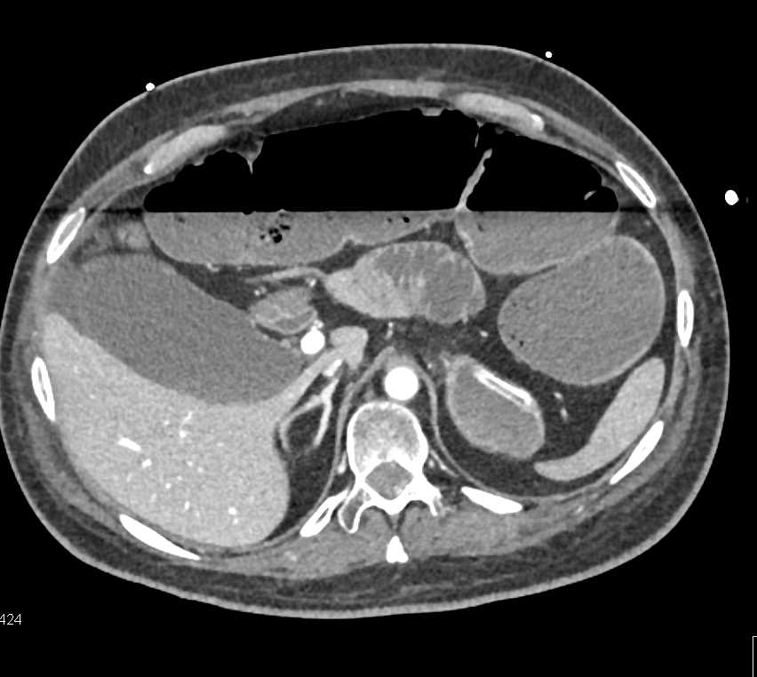 Colon Obstruction by a Colon Cancer - CTisus CT Scan