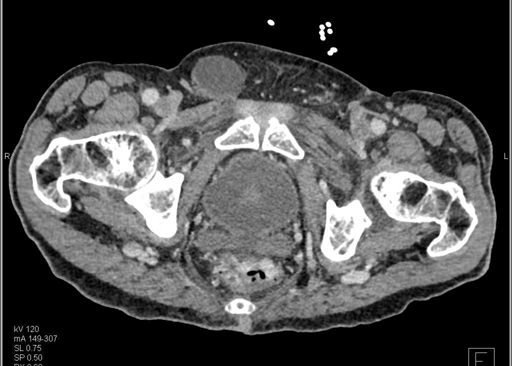 Rectal Varices and Cirrhosis of the Liver in Gastrointestinal (GI) Bleed Patient - CTisus CT Scan