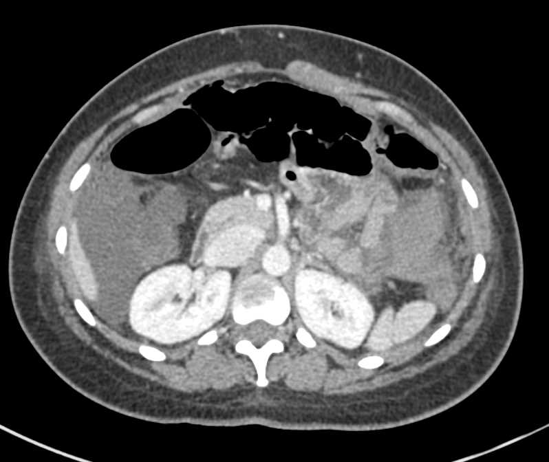 Right Lower Quadrant Active Bleed with Hemoperitoneum - CTisus CT Scan