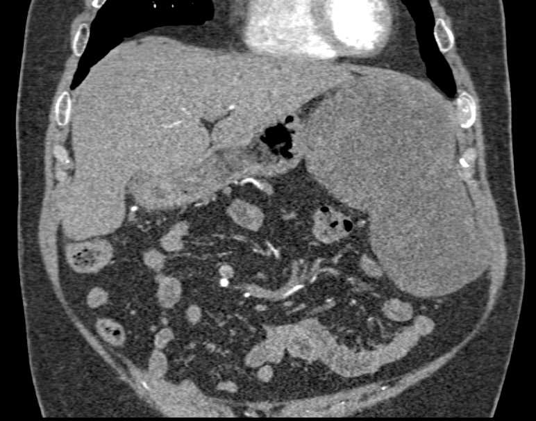 Carcinomatosis with Pancreatic Pseudocyst - CTisus CT Scan