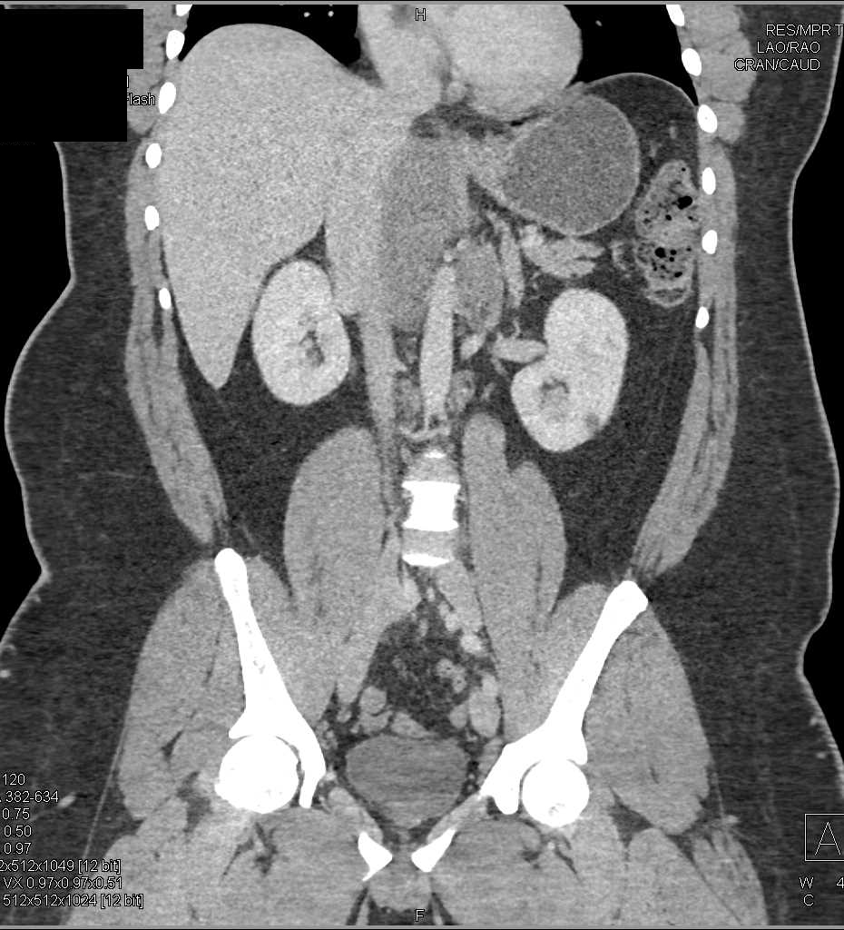 Lymphoma with Extensive Adenopathy - CTisus CT Scan