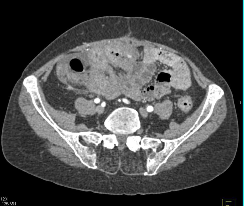 Carcinomatosis with Nodes and Renal Metastases - CTisus CT Scan