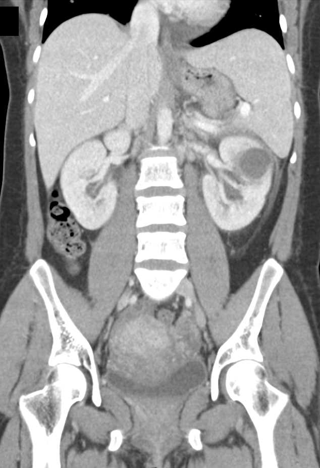 Carcinomatosis with Nodes and Renal Metastases - CTisus CT Scan