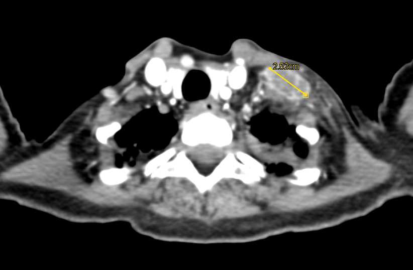 Left Upper Quadrant Sarcoma with Extensive Metastases - CTisus CT Scan