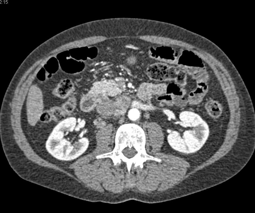 Perigastric Tumor with Extensive Adenopathy - CTisus CT Scan