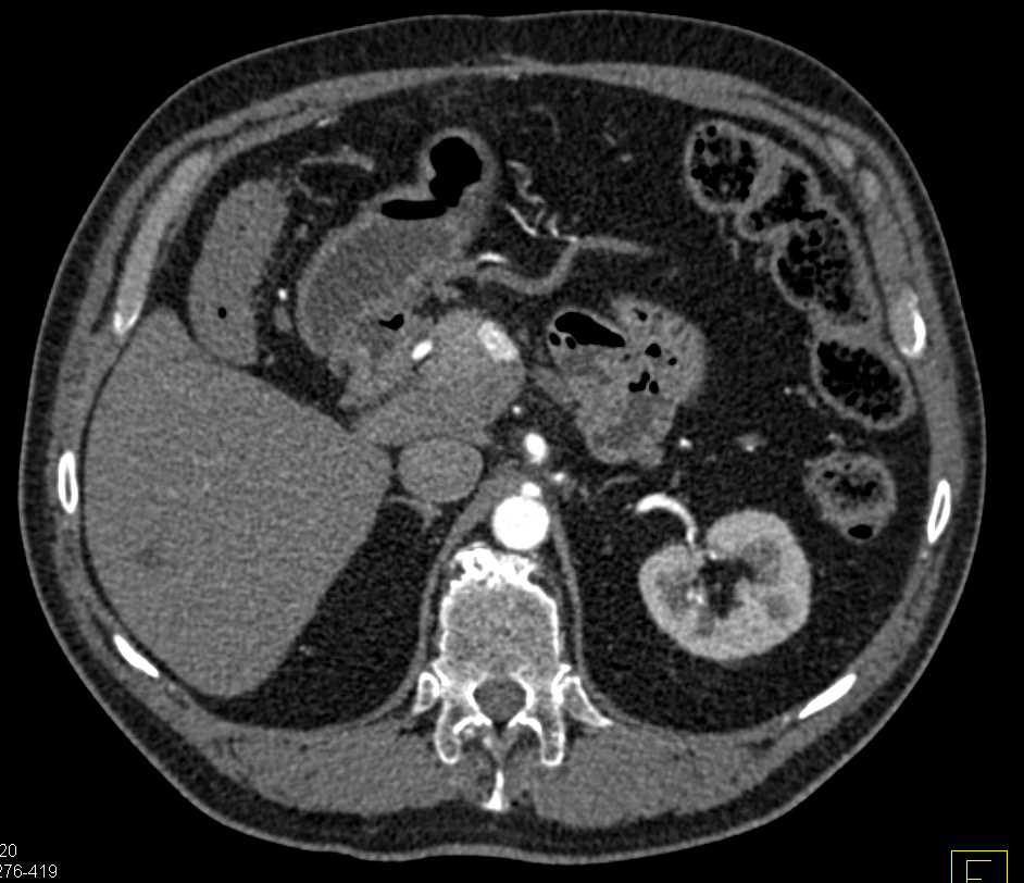 Neuroendocrine Tumor 1 cm in Head of the Pancreas - CTisus CT Scan