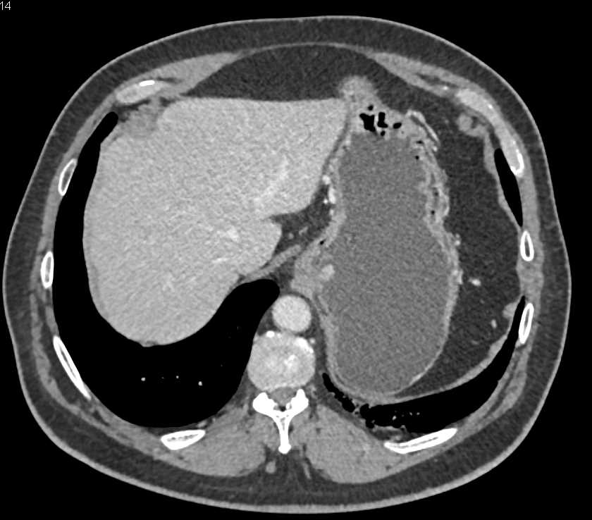 Carcinoma of the EG Junction - CTisus CT Scan