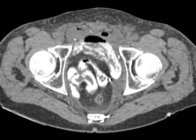 Thickening of Bowel due to Prior Radiation Therapy - CTisus CT Scan