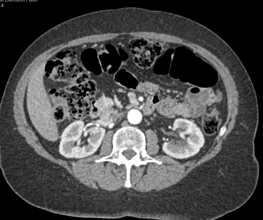 Recurrent Neuroendocrine Tumor in the Pancreatic Bed - CTisus CT Scan