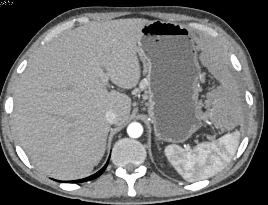 Carcinomatosis with Extensive Tumor and Adenopathy - CTisus CT Scan