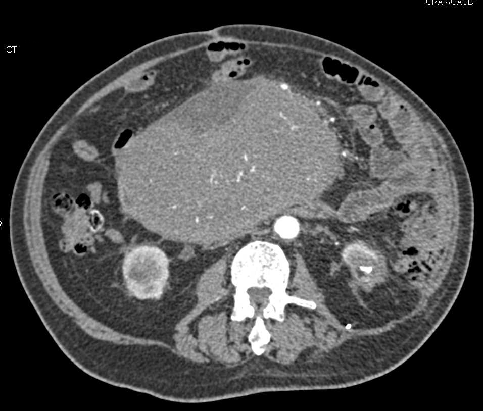 Small Bowel GIST Tumor - Gastrointestinal Case Studies - CTisus CT Scanning