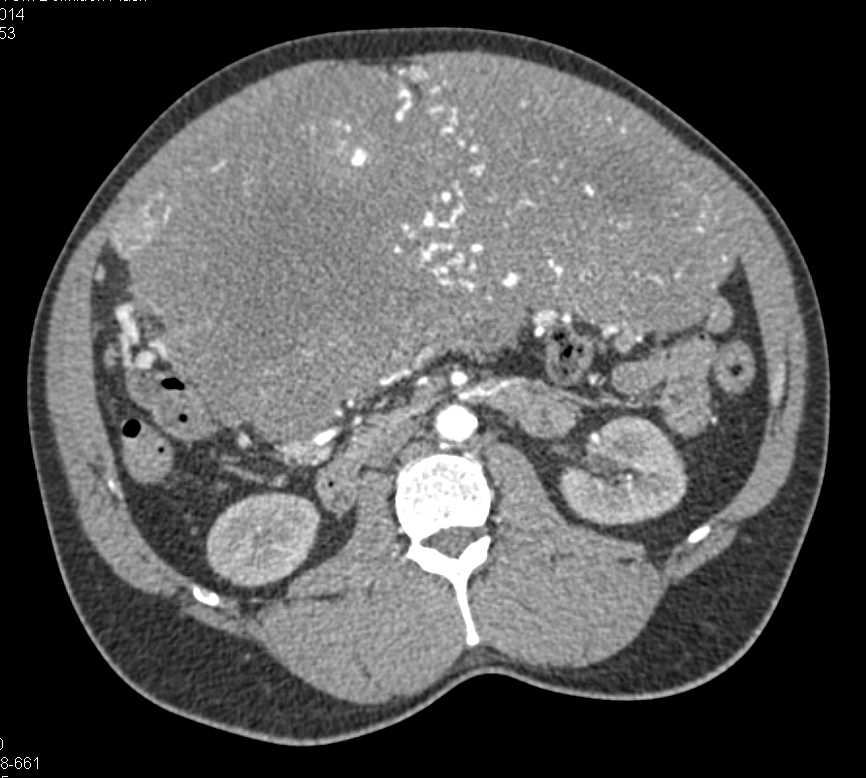 Large Abdominal GIST Tumor - CTisus CT Scan