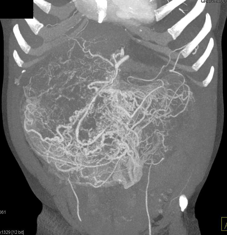 Large Abdominal GIST Tumor - CTisus CT Scan