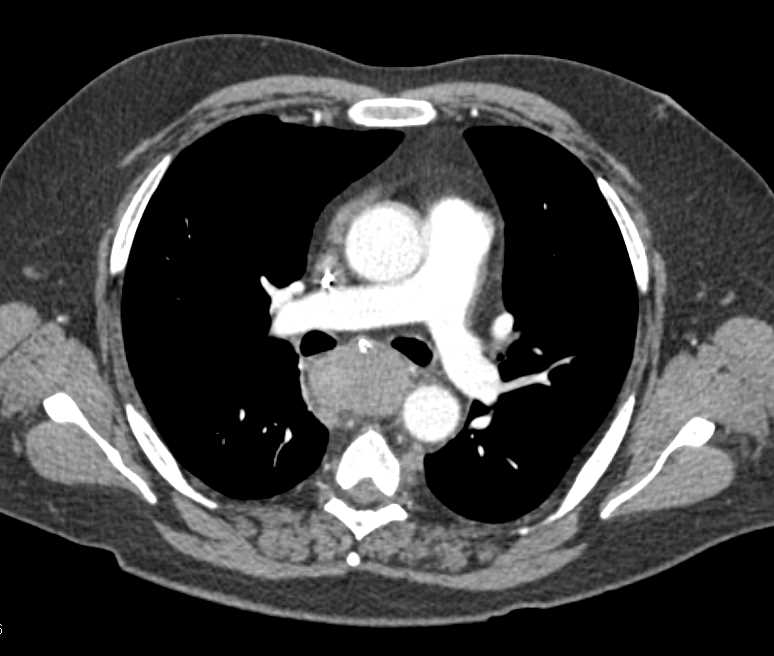 Lymphoma With Extensive Adenopathy Especially in the Mediastinum - CTisus CT Scan