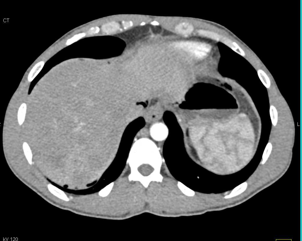 Pneumoperitoneum due to Perforated Rectum - CTisus CT Scan