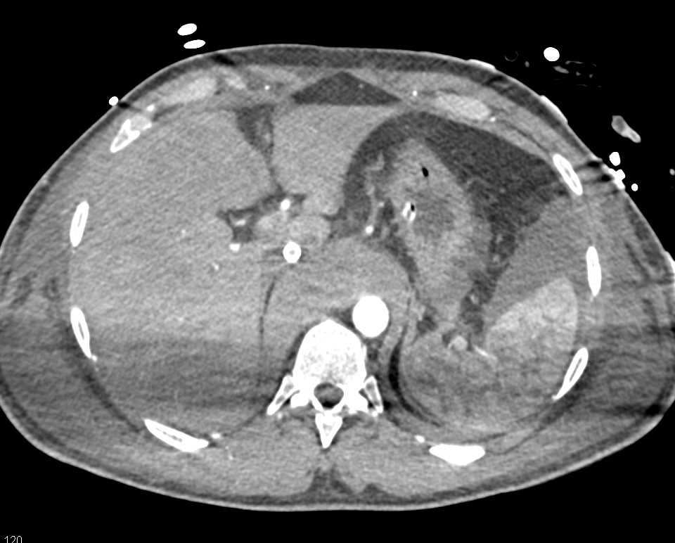 Retroperitoneal and Intraperitoneal Bleed - CTisus CT Scan