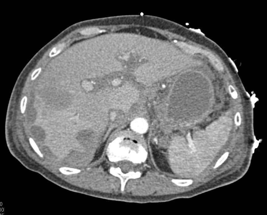 Pseudomyxoma Peritonei (PMP) with Scalloping of the Liver Surface - CTisus CT Scan