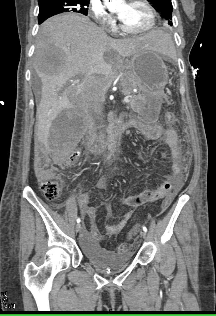 Pseudomyxoma Peritonei (PMP) with Scalloping of the Liver Surface - CTisus CT Scan