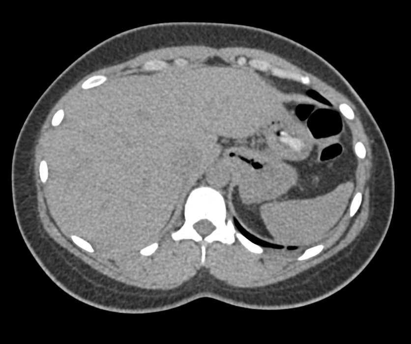 Foreign Bodies in Soft Tissues and in Bowel - CTisus CT Scan