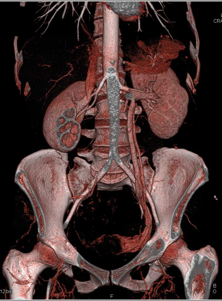 Gastric Adenocarcinoma - CTisus CT Scan