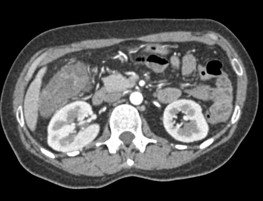 Colitis of the Rightand Transverse  Colon without Abscess - CTisus CT Scan