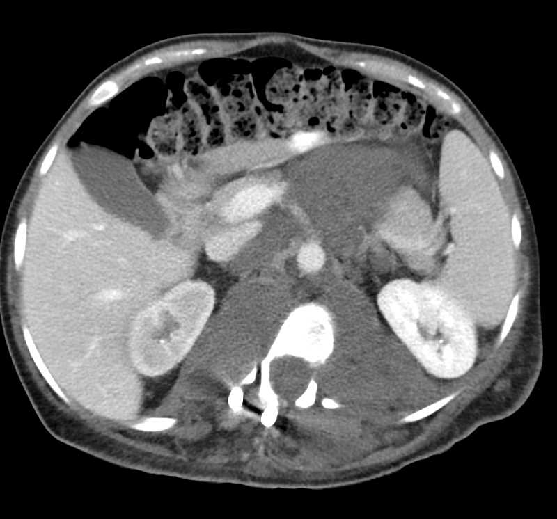 Neurofibromatosis with Extensive Masses in Abdomen and Para-Aortic Regions - CTisus CT Scan