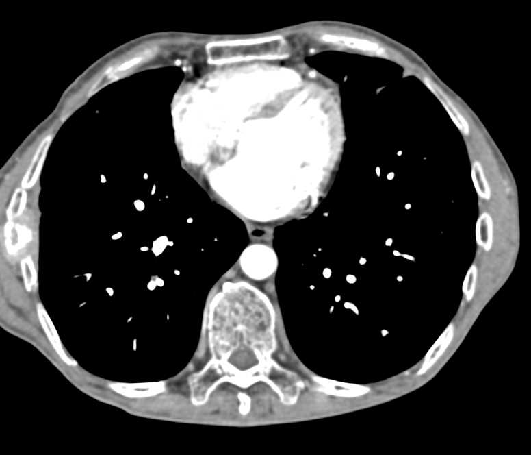 Metastatic Carcinoid Tumor with Implants on Liver and Diaphragm - CTisus CT Scan