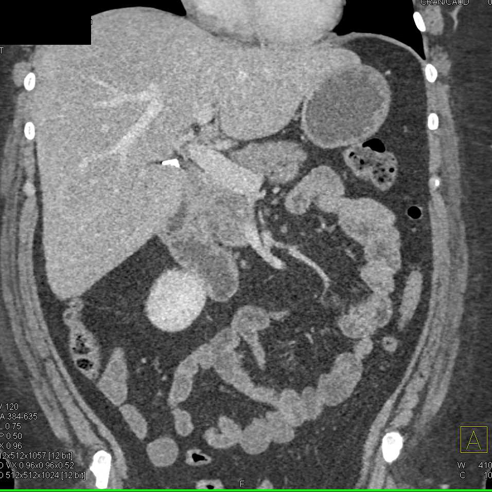 Peripancreatic Nodes in a Patient with Cecal Cancer - CTisus CT Scan