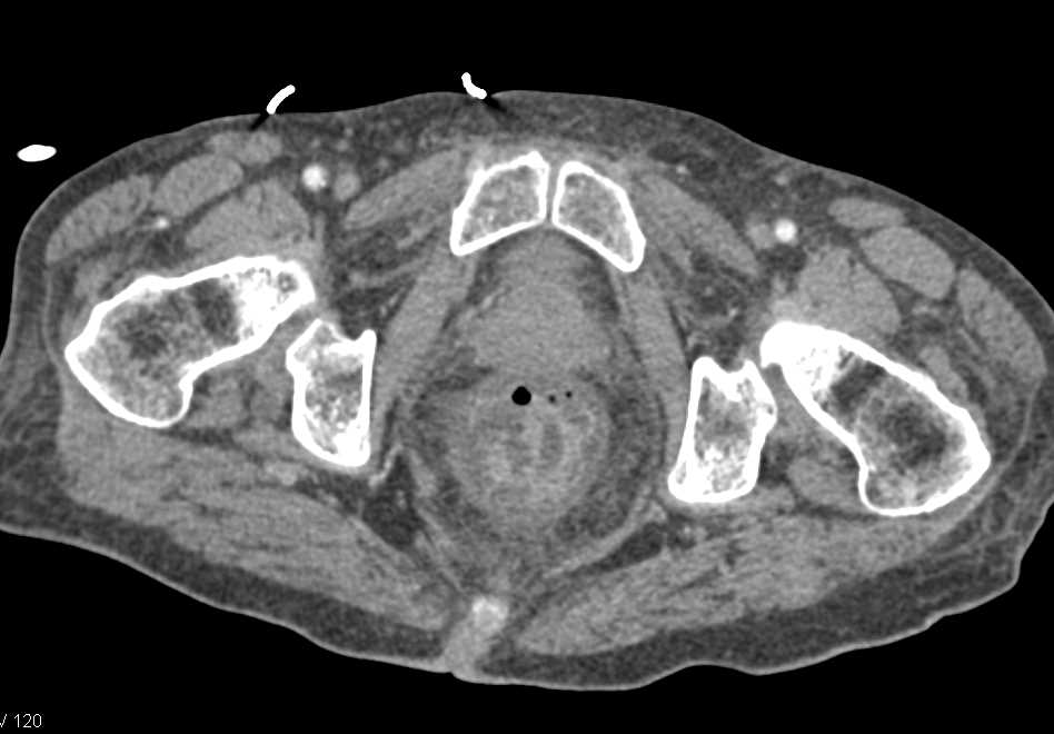 Gastritis and Pseudomembranous Colitis - CTisus CT Scan