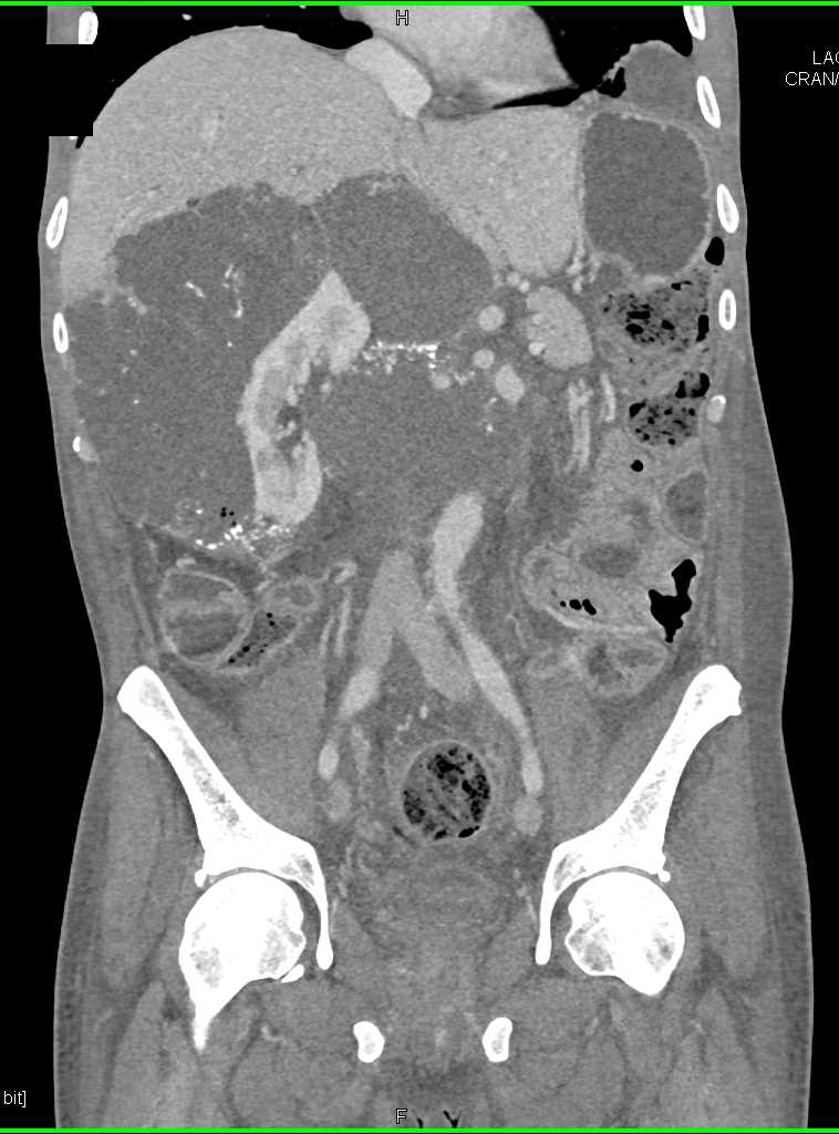 Pseudomyxoma Peritonei (PMP) with Scalloping of the Liver Surface - CTisus CT Scan