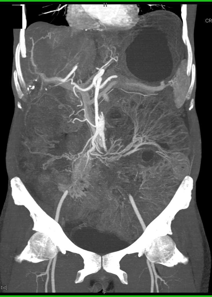 Superior Mesenteric Artery (SMA) Syndrome with Obstruction of the Duodenum and the Stomach - CTisus CT Scan