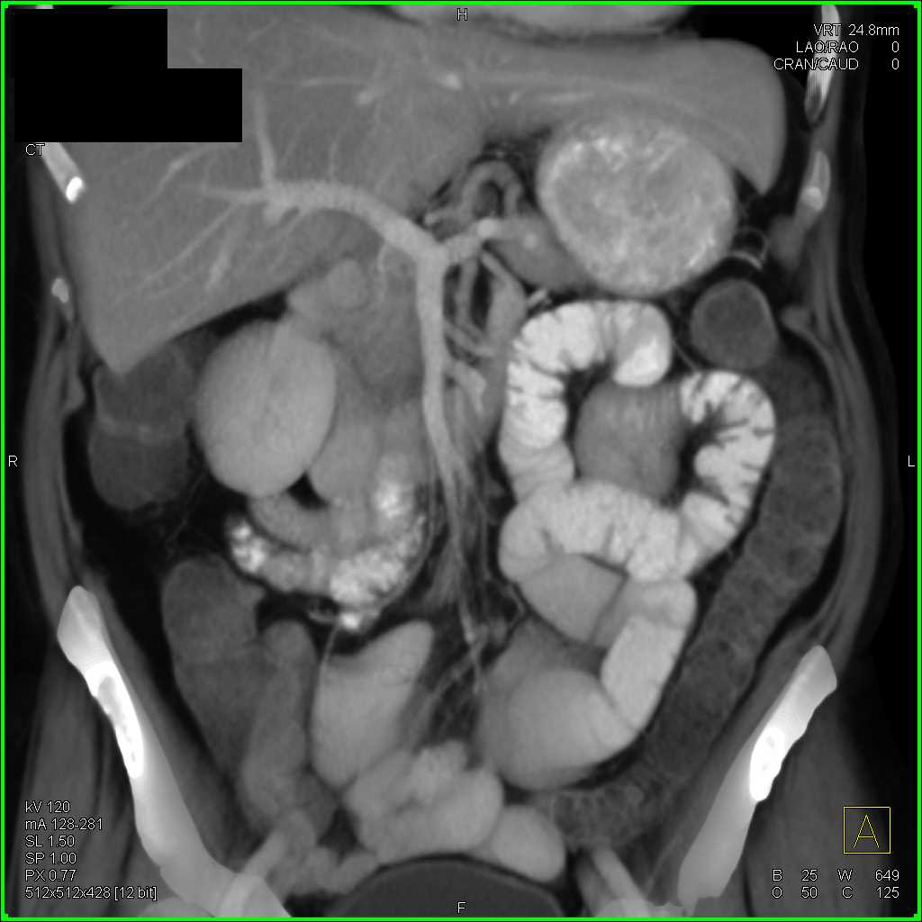 Superior Mesenteric Artery (SMA) Syndrome with Obstruction of the Duodenum and the Stomach - CTisus CT Scan