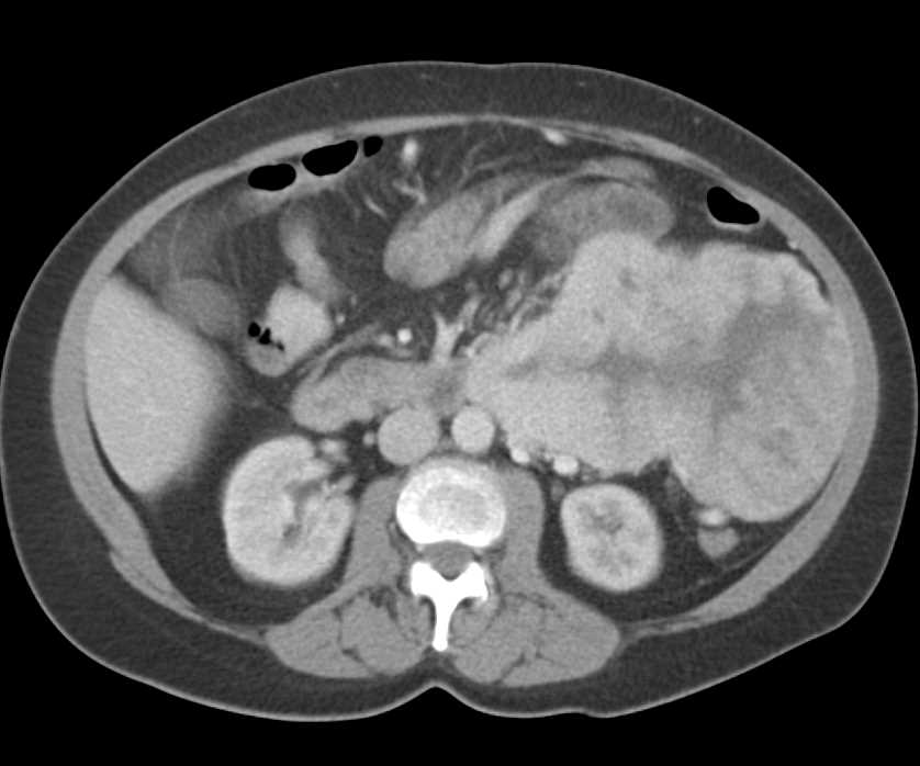 Multiple Leiomyosarcomas in the Abdomen and Pelvis - CTisus CT Scan