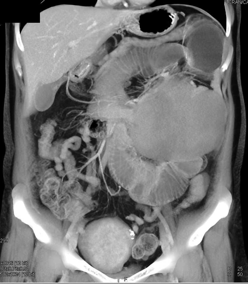 Sarcoma in the LUQ - Gastrointestinal Case Studies - CTisus CT Scanning