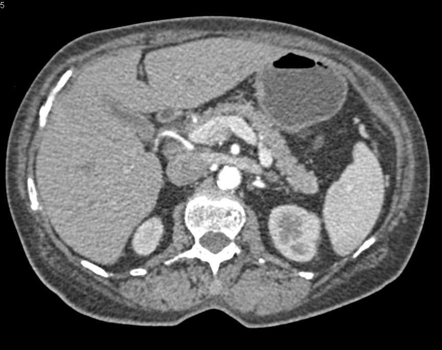 Media Arcuate Ligament Compression due to Shunt - CTisus CT Scan