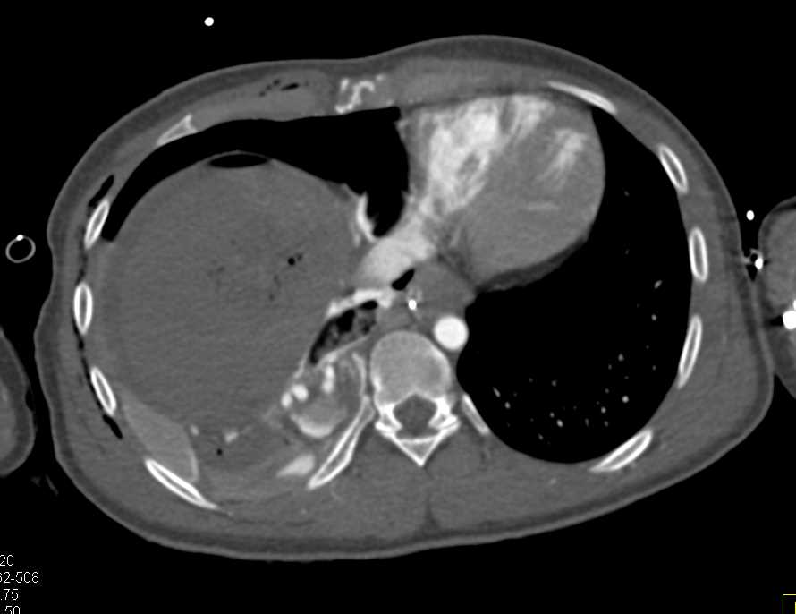 Pneumoperitoneum with Gastrointestinal (GI) Bleed - CTisus CT Scan