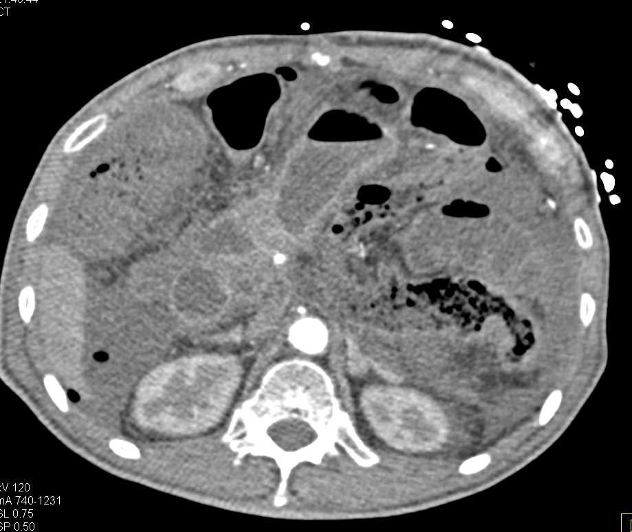 Carcinomatosis with Infiltration Mesentery - CTisus CT Scan