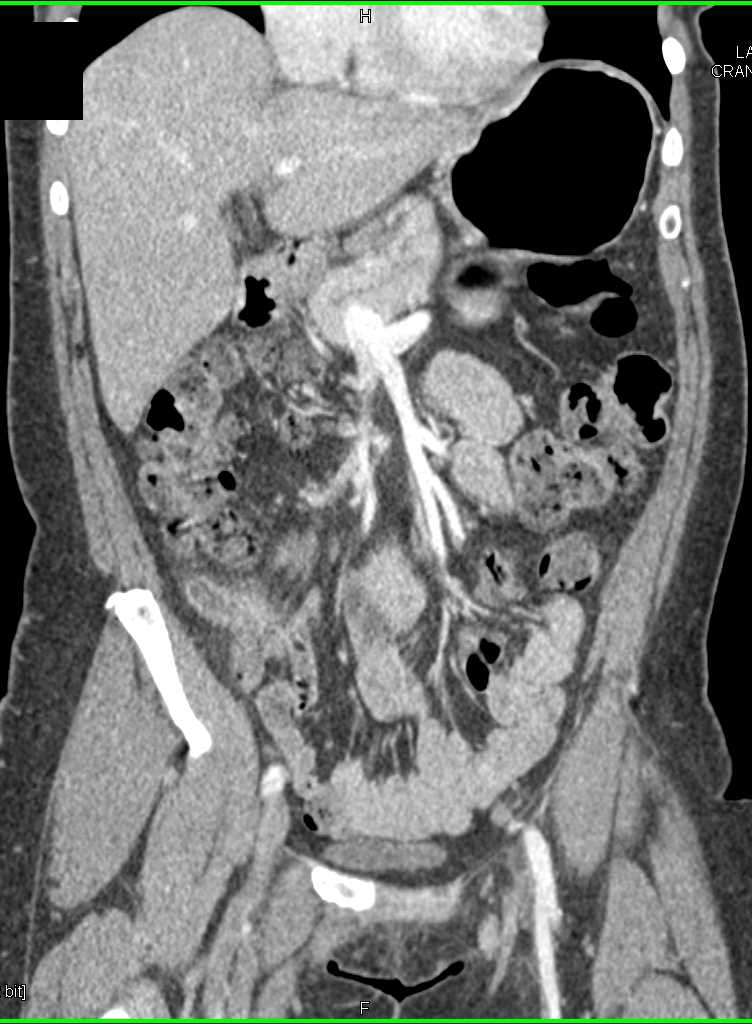 Acute Appendicitis - CTisus CT Scan