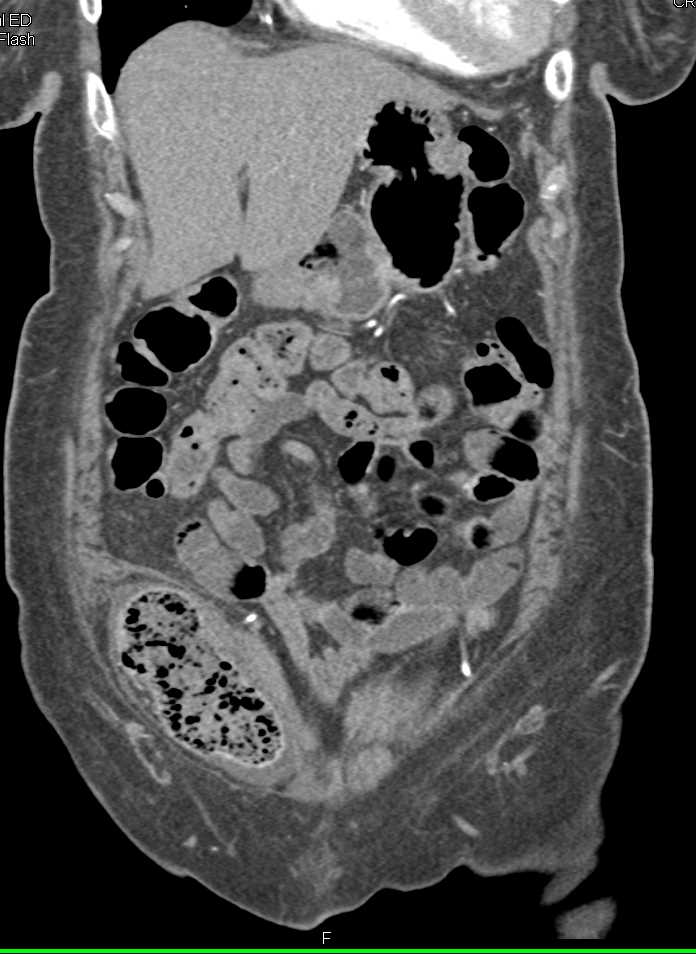 Bowel Hernia Right Lower Quadrant with Distended Loop - CTisus CT Scan