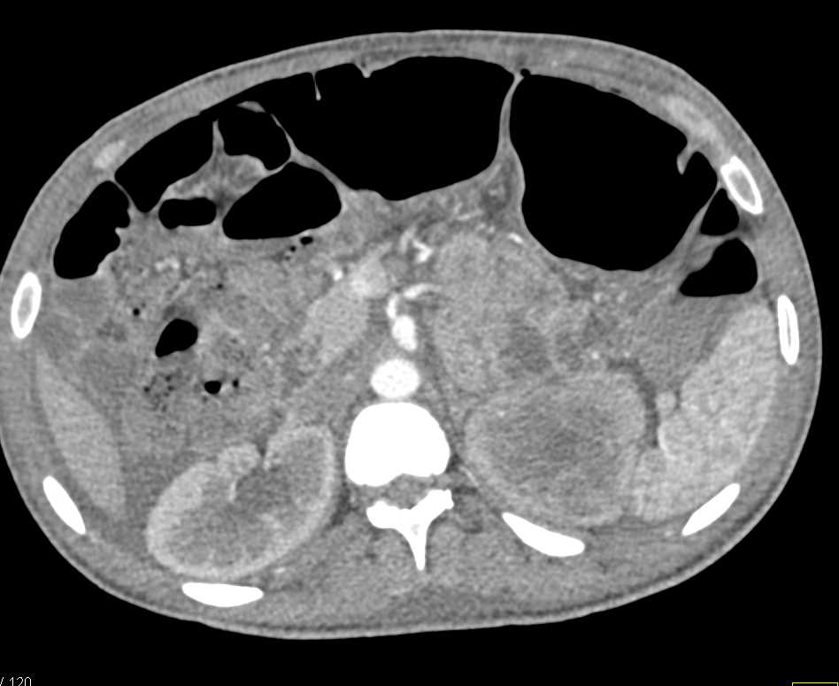 Retroperitoneal Sarcoma Obstructs the Left Kidney - CTisus CT Scan