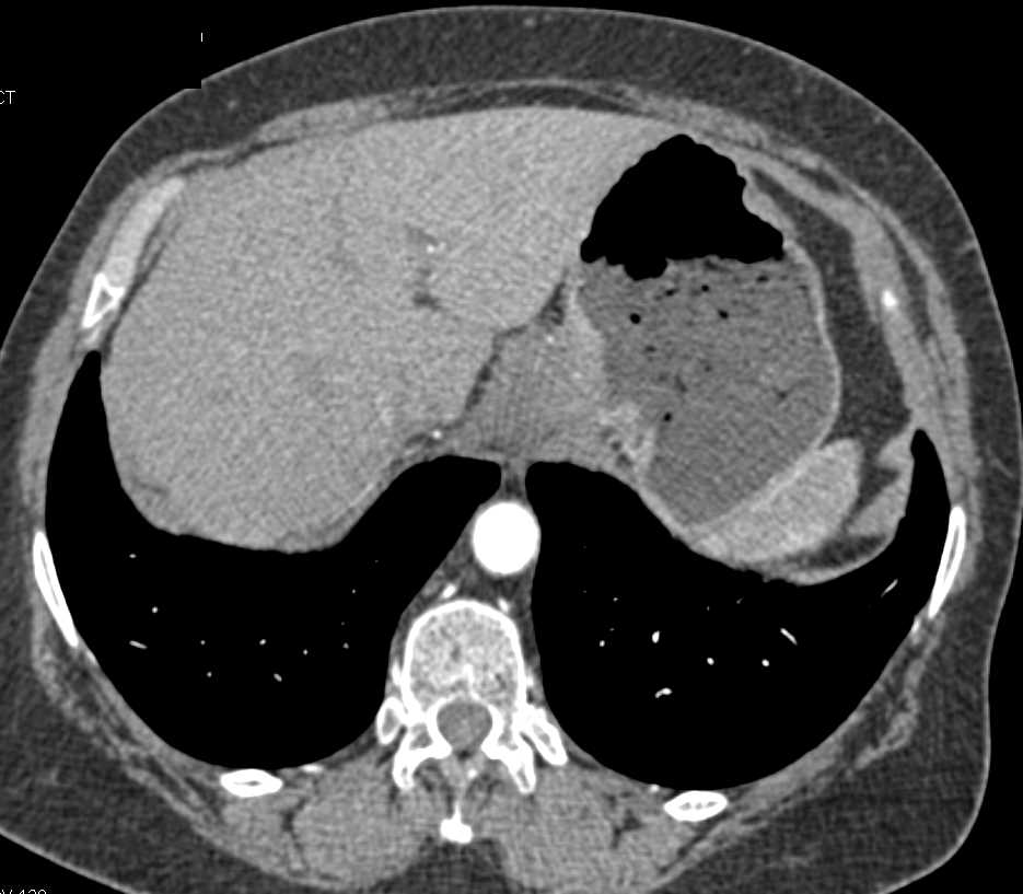 Carcinoma Gastroesophageal (GE) Junction Encases Celiac Artery - CTisus CT Scan