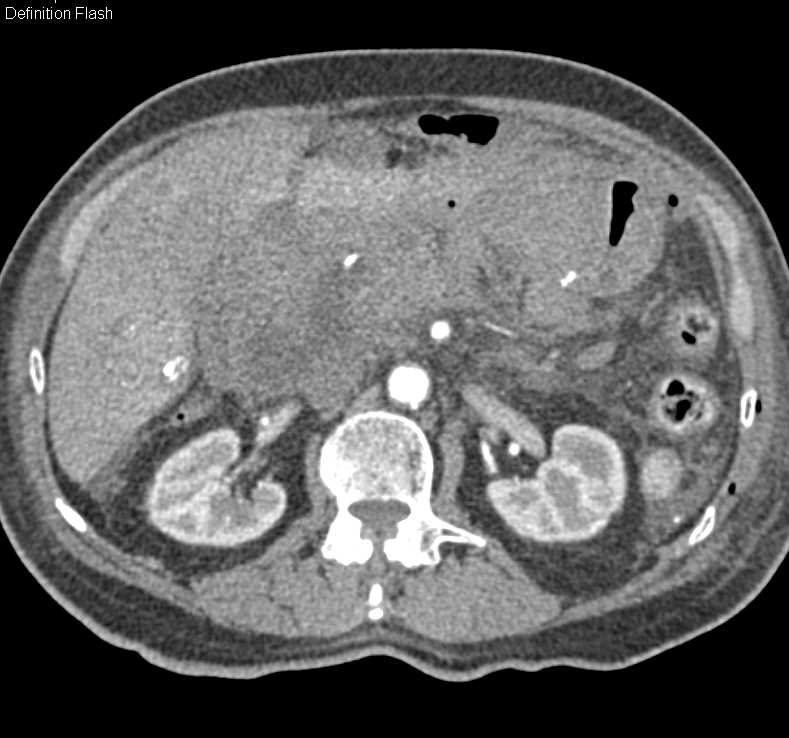 Active Bleed Following Gastric Surgery - CTisus CT Scan